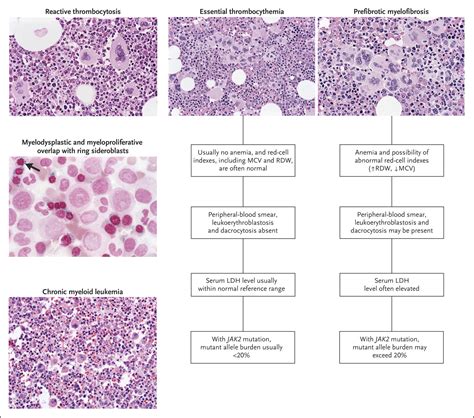 Essential thrombocythemia